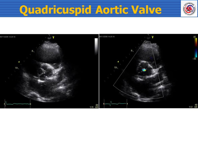 Quadricuspid Aortic Valve
